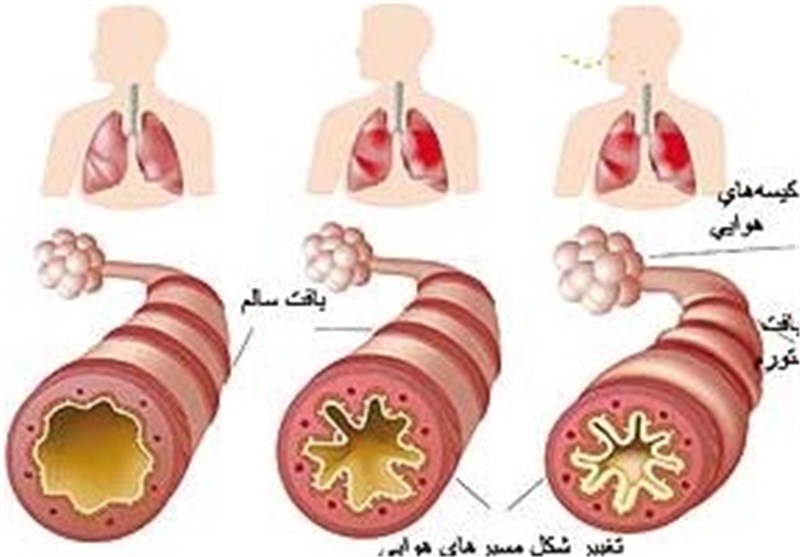 بهترین ورزش ها برای مبتلایان به آسم