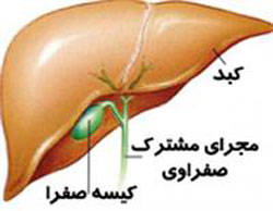 چگونه سنگ کیسه صفرا را درمان کنیم؟