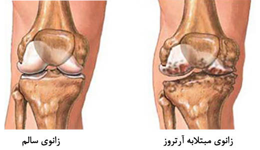 این غذاها آرتروز را تشدید می کند این غذاها آرتروز را تشدید می کند