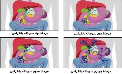 انواع «سرطان» در یک نگاه! انواع «سرطان» در یک نگاه!