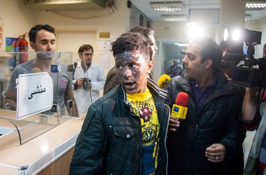 سوختگی شدید در ناحیه صورت