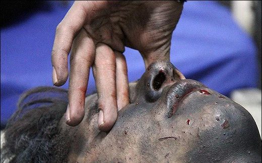 سوختگی شدید در ناحیه صورت و آسیب جدی به چشم